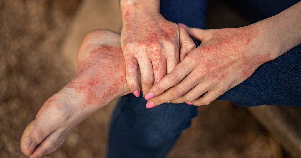Dermatitis atópica: por qué se detectan cada vez más casos en adultos
