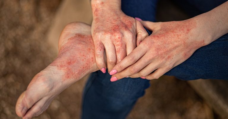 Dermatitis atópica: por qué se detectan cada vez más casos en adultos